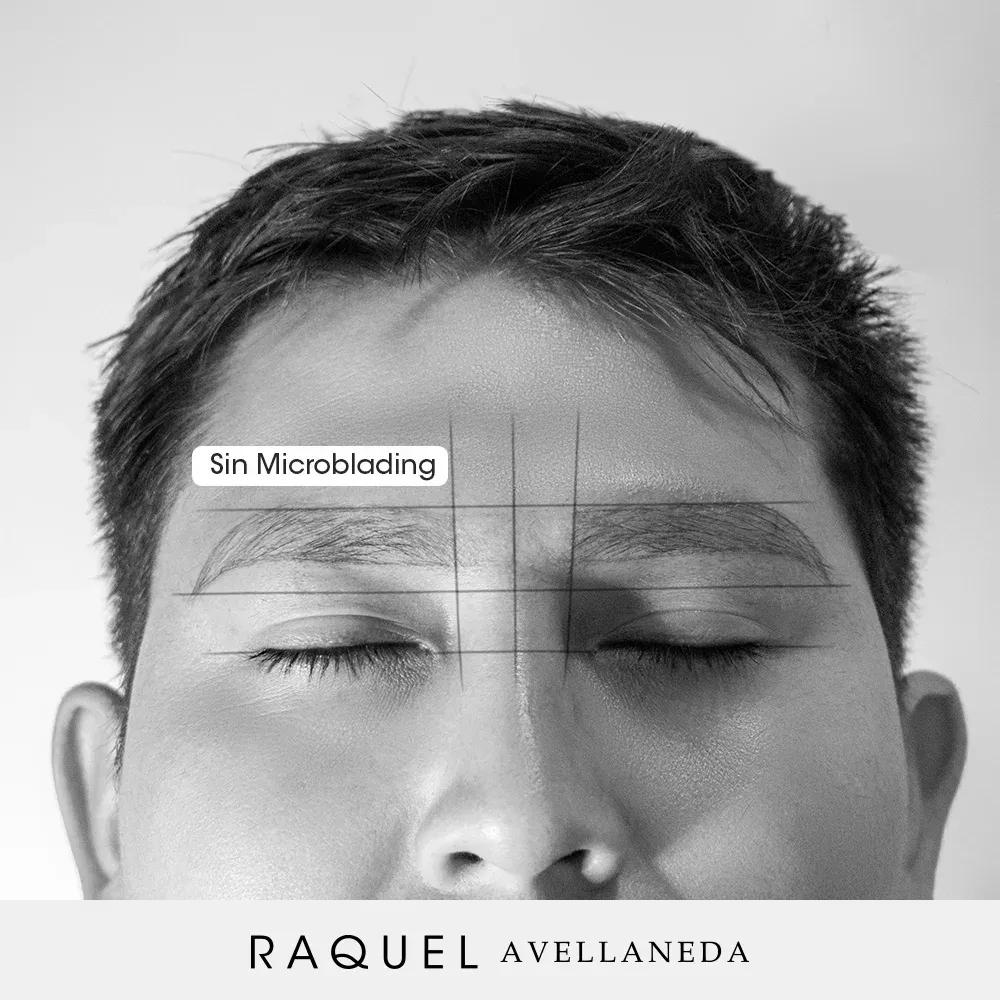 Caso 02 · Microblading masculino antes